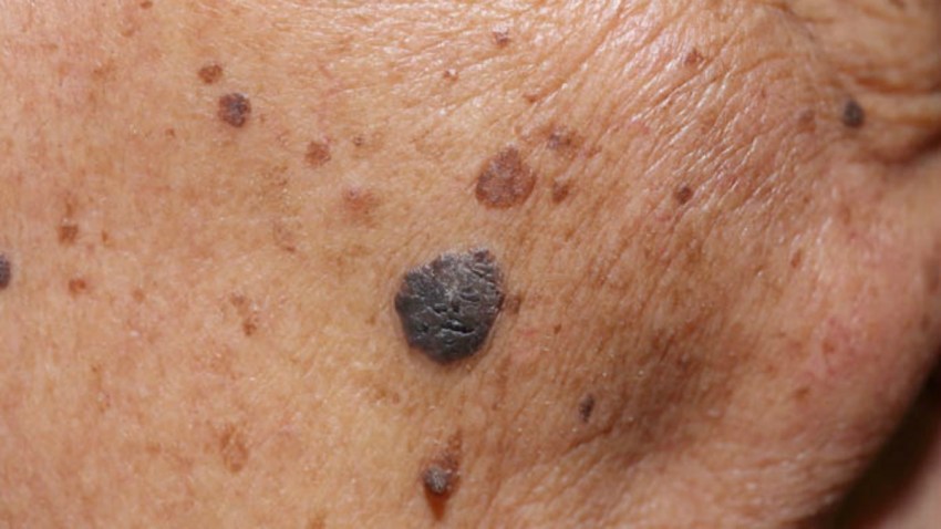 TLMD-lunar-melanoma-cancer-de-piel-shutterstock_265690370-portada