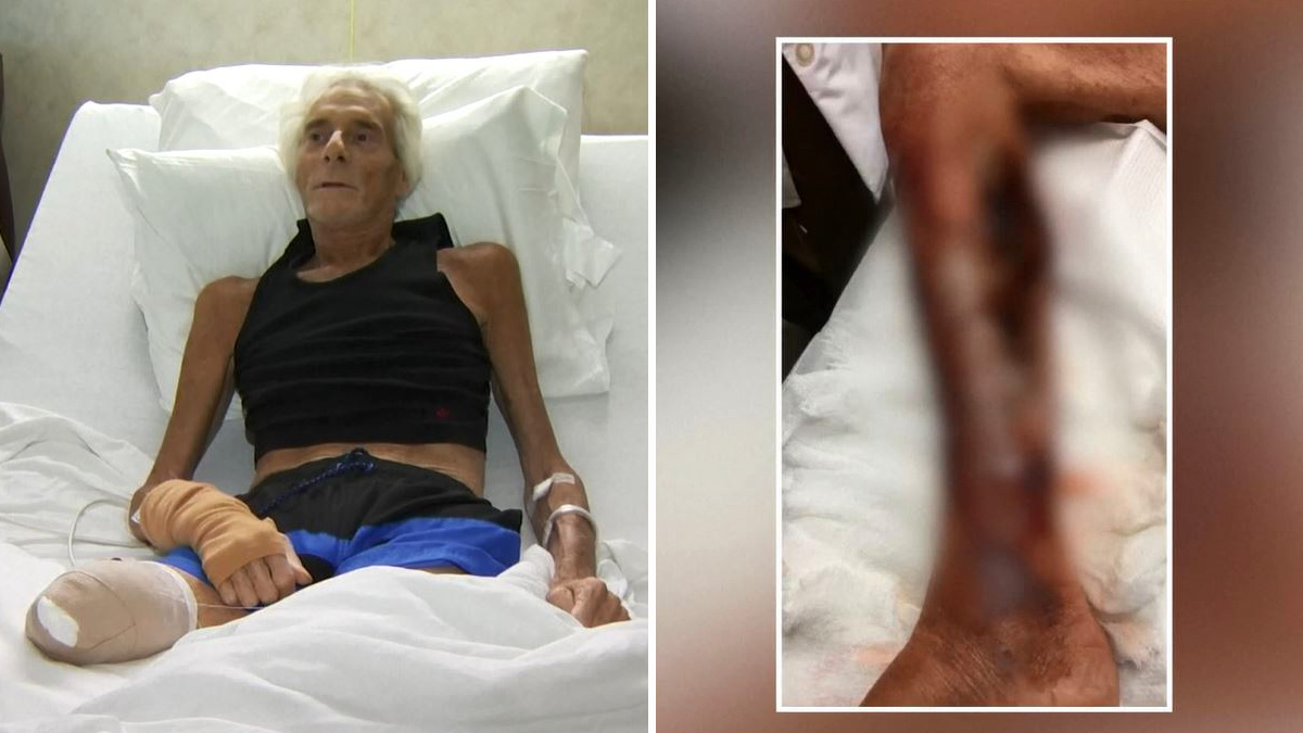 Anciano Contrae Bacteria Comecarne Tras Nadar En El 225 Rea