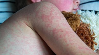Sarampión en el cuerpo de un niño.