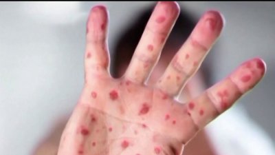 Texas tiene el mayor brote de sarampión desde el año 2000